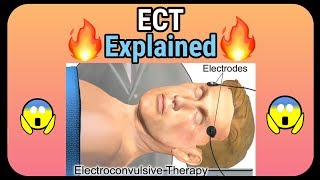 Electroconvulsive therapy ECT explained  How it is performed [upl. by Tenrag117]