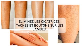 COMMENT ÉLIMINER LES CICATRICES ET BOUTONS SUR LES JAMBES [upl. by Duyne]