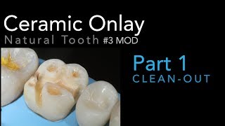 Lithium Disilicate Ceramics Part 1 Ceramic Onlay CleanOut 3 MOD [upl. by Potts]