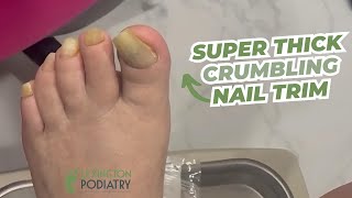 SUPER THICK Crumbling Nail Trim [upl. by Annavaig234]