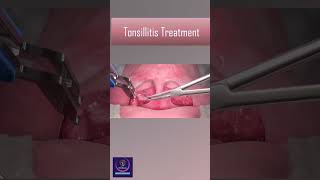 Tonsillitis Treatment With Heat Device tonsillitis [upl. by Morocco]