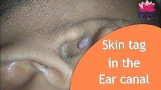 Skin tag in the Ear canal removed with laser  Dr Anand Jaiswals MayaSkinclinic M5 [upl. by Netneuq]