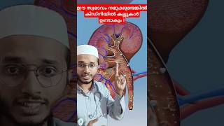 Kidney stone formation Dr Muhammed Shibili healthtips [upl. by Animaj]