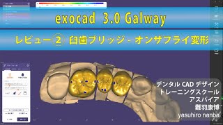 exocad 30 Galway レビュー ② 臼歯ブリッジオンザフライ変形 [upl. by Ais802]