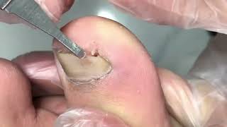 Deep Black Ingrown Toenail Got Digged Out by Professional【Yinuo Pedicure】 [upl. by Antonia18]