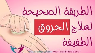 الطريقة الصحيحة لعلاج الحروق في المنزل [upl. by Ayyidas]