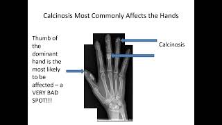 Calcinosis in Scleroderma Carrie Richardson MD MHS [upl. by Gnas681]