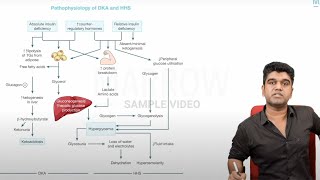 E6 Sample Video Diabetic Ketoacidosis Medicine [upl. by Aikemahs]