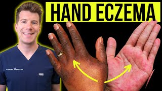 Doctor explains how to recognise and treat HAND ECZEMA dermatitis  Causes symptoms amp prevention [upl. by Tnomed]