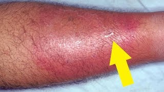 5 Effective and Easy Home Remedies for Cellulitis [upl. by Malorie84]