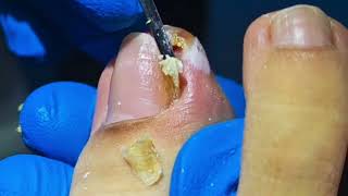 WARNING Dont Try to Remove an Ingrown Toenail Without Watching This [upl. by Floria]