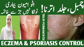 Most Easiest Way To Cure Eczema ampPsoriasis Psoriasis Treatment  Best 2 Remedies Listen Your Body [upl. by Nilrac]