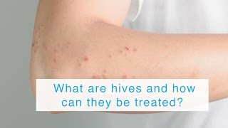 What are hives and how can they be treated [upl. by Nolaf]