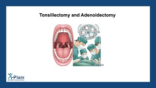 Tonsillectomy and Adenoidectomy [upl. by Eirellav169]