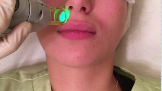 Laser hair removal upper lip with the Alexandrite GentleLase Pro [upl. by Tayib247]