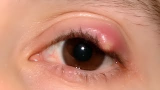 Chalazion Cyst [upl. by Hebrew576]