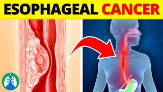 Top 10 Early Warning Signs of Esophageal Cancer  NEVER Ignore THIS [upl. by Jovia]