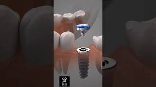 Dental Implant Procedure oralsurgery implantologist implanteducation oralimplantology [upl. by Firestone52]