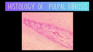 Histology of Pulpal Fibrosis  Dentistry [upl. by Rases]