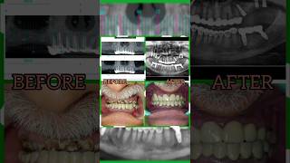 Screw Retained Fixed Ceramic DLMS CadCam Prosthesis  dentalimplantsnearme  Best Implant Center [upl. by Oakman]