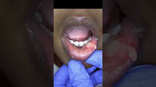 Pediatric Chewed Lip after Dental Anesthesia [upl. by Mali]