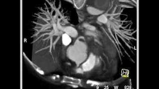 Type B dissection with compression of true lumen [upl. by Helli200]