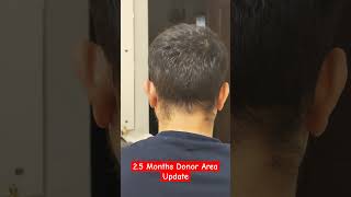 25 Months Donor Area Update After HAIR TRANSPLANT besthairtransplant qht dhi [upl. by Noteek]