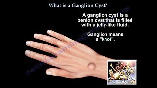 What Is A Ganglion Cyst  Everything You Need To Know  Dr Nabil Ebraheim [upl. by Cesaria231]