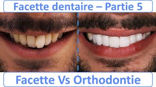 Facette dentaire Vs Orthodontie  Guide complet  partie 5 [upl. by Ajed954]