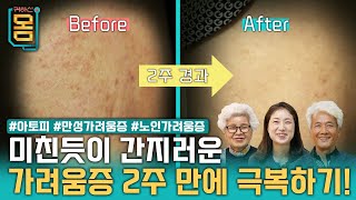 Full 미친듯이 간지러운 가려움증 2주 만에 극복하기 아토피만성가려움증노인가려움증ㅣ귀하신 몸ㅣ52화 가려워서 미치겠어요 가려움증 [upl. by Beatty930]