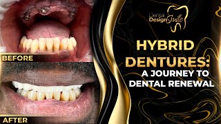 Hybrid Dentures A Journey to Dental Renewal [upl. by Tsuda245]