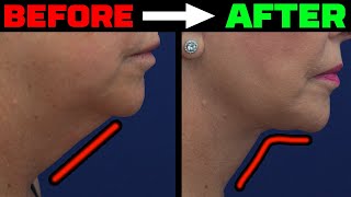 How Does Your Neck Age Facelift Expert [upl. by Reames]