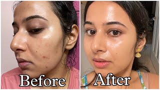 Simple Tretinoin Night Skincare Routine for Acne free Glowing Skin skincare skincareroutine [upl. by Ahsinev]