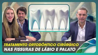 Tratamento Ortodôntico Cirúrgico nas fissuras de lábio e palato [upl. by Glass747]