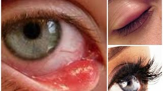 easiest way to get rid of eye stye [upl. by Anen108]