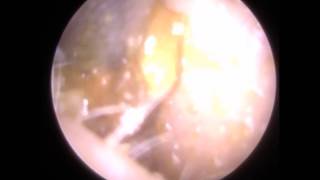 229  Otitis Externa of Eardrum Revealed after Endoscopic Ear Wax Removal [upl. by Ademla]