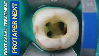 Root Canal Treatment in Mandibular Molar ⚪️ Protaper Next 🔵 Step By Step Demonstration [upl. by Pontone992]