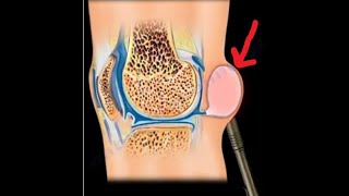 Bakers Cyst its relationship to meniscus tears and knee arthritis [upl. by Akienat688]