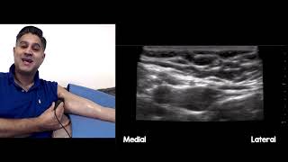 Medial Antebrachial Cutaneous Nerve block medial cutaneous nerve of the forearm [upl. by Dareg]