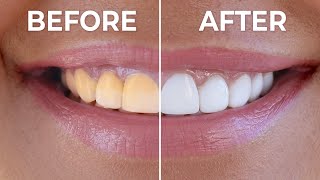 Instant Teeth Whitening At Home  How To Naturally Whiten Yellow Teeth [upl. by Gable969]