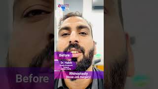 Rhinoplasty Before amp After Result  Amazing Transformation [upl. by Ralf]