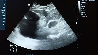 Hydronephrosis and hydroureter ultrasound examination [upl. by Ekle]