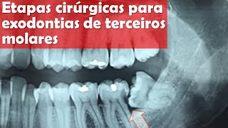 Etapas cirurgicas para exodontias de terceiros molares  Odontologia  Dra Bianca Rosa [upl. by Remmer637]