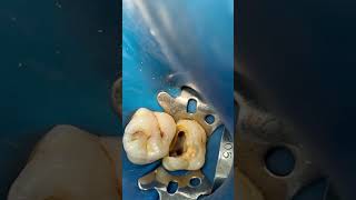 Molar 🦷 root canal treatment dentist dental dentalprocedure [upl. by Suckram361]