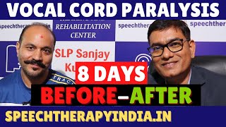 BeforeAfter  Unilateral Vocal Cord Paralysis Phonatory Gap  8 Days Treatment  slpsanjaykumar [upl. by Gnoix]