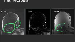 Breast MRI  common findings and cases [upl. by Stimson884]