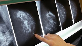 New drug Trodelvy offers hope for breast cancer patients [upl. by West]