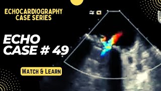 Echocardiography Case 49 Echo Spot Diagnosis Series  Cardiology TOACS [upl. by Hawker]