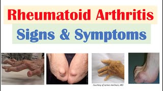 Rheumatoid Arthritis RA Signs amp Symptoms amp Associated Complications [upl. by Nylahsoj]