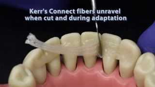 Ribbond compared to other dental fiber reinforcement materials [upl. by Ayanej]